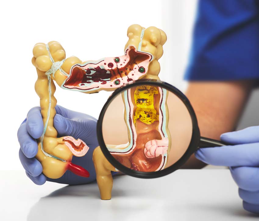 Researchers Identify Promising New Target for Colorectal Cancer Treatment colorectalcancerig26